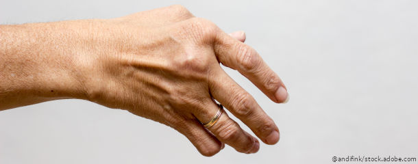Rhematoide Arthritis pflegerische Maßnahmen