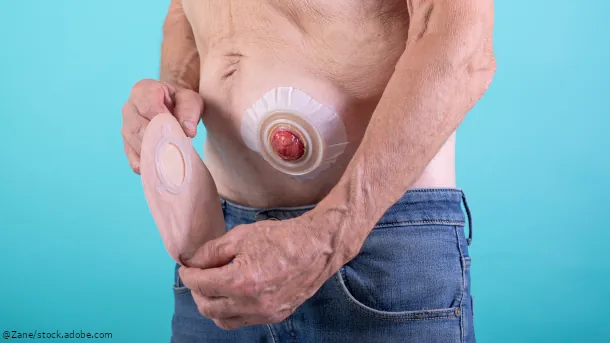 Stoma Versorgung und Pflege